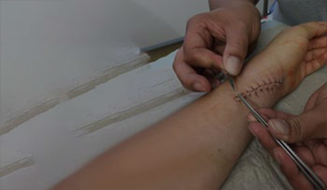 Suture removal